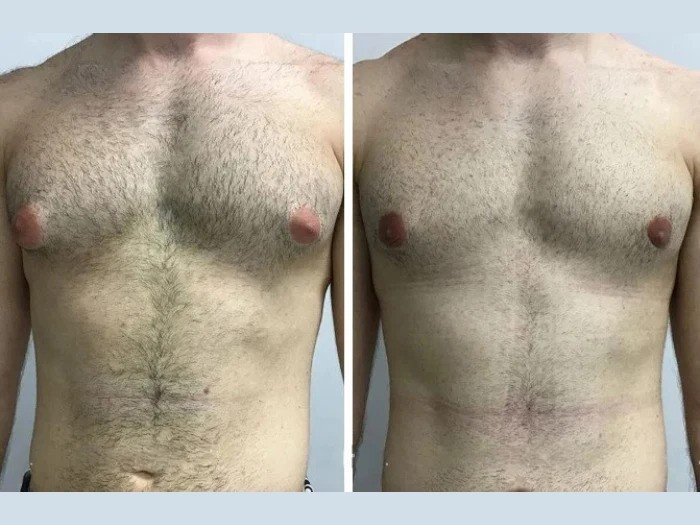 Gynecomastia Surgery in Dubai: Transform Your Confidence with Expert Care